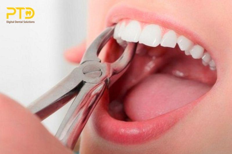 Bảo tồn ổ nhổ răng (ESP)