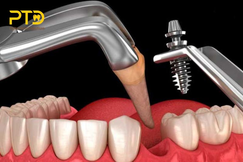 Các tiêu chí lựa chọn máy cắm ghép Implant chất lượng