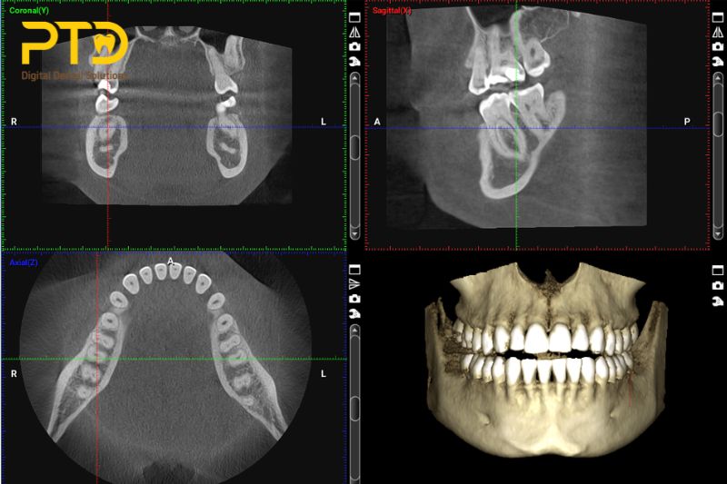 Công nghệ chụp phim hiện đại Cone Beam CT (CBCT) có gì khác với CT thông thường?