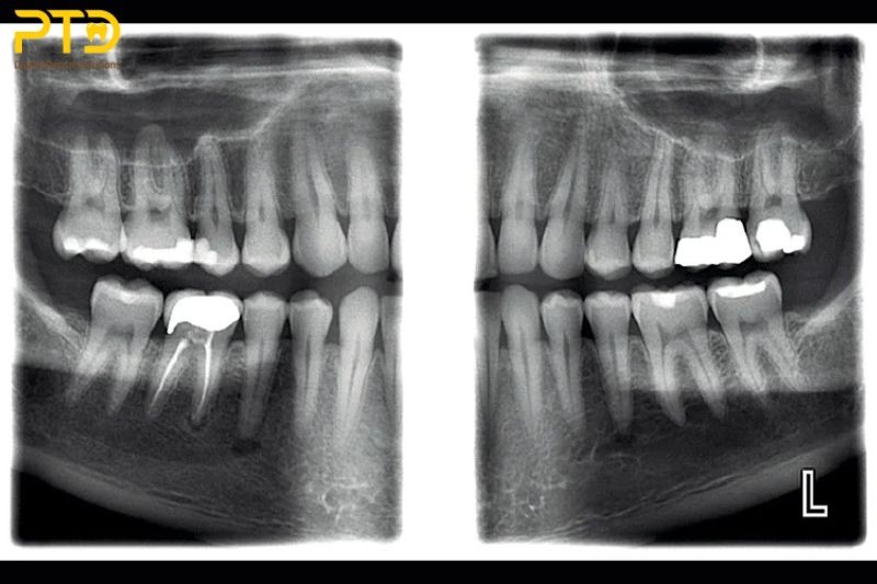 Chụp X-quang 2D thông thường