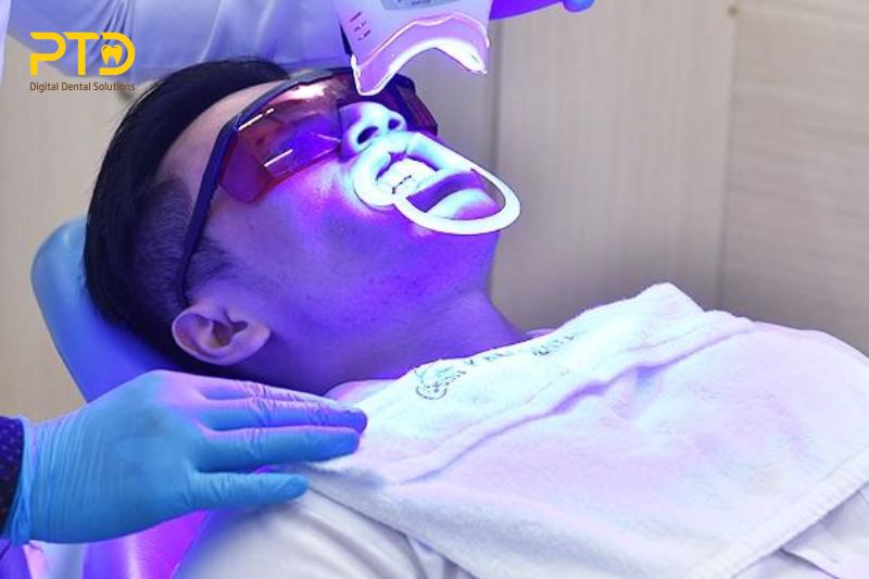 Đèn tẩy trắng răng là gì?