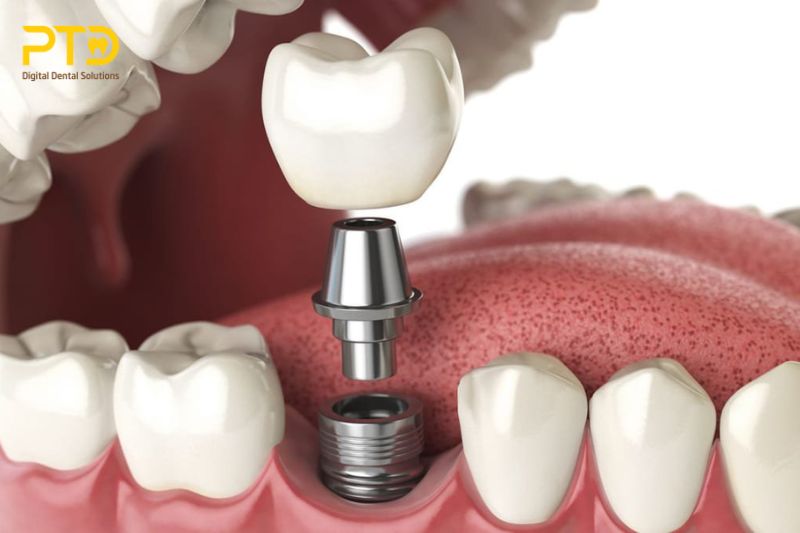 Guidance on the standards of care for NHS-funded dental implant