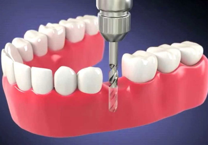 Máy cắm implant là thiết bị chuyên dụng trong nha khoa