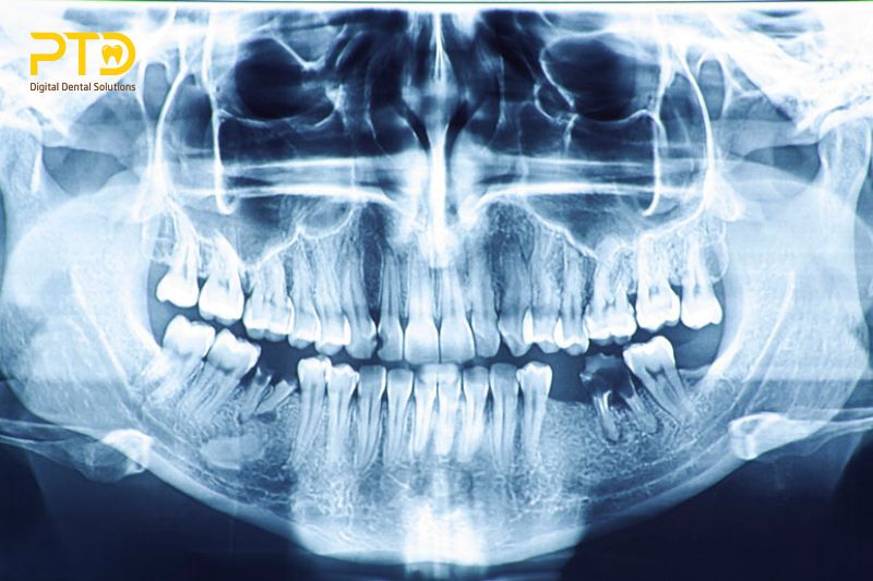 Tầm quan trọng của máy chụp X-quang nha khoa và khả năng chẩn đoán hình ảnh