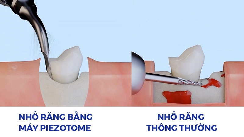 Nguyên lý hoạt động của máy Piezotome