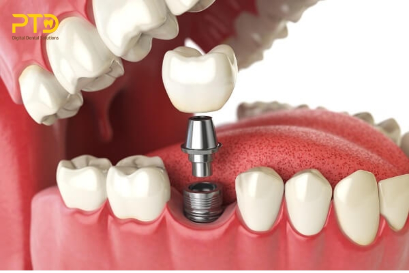 Răng implant là gì?