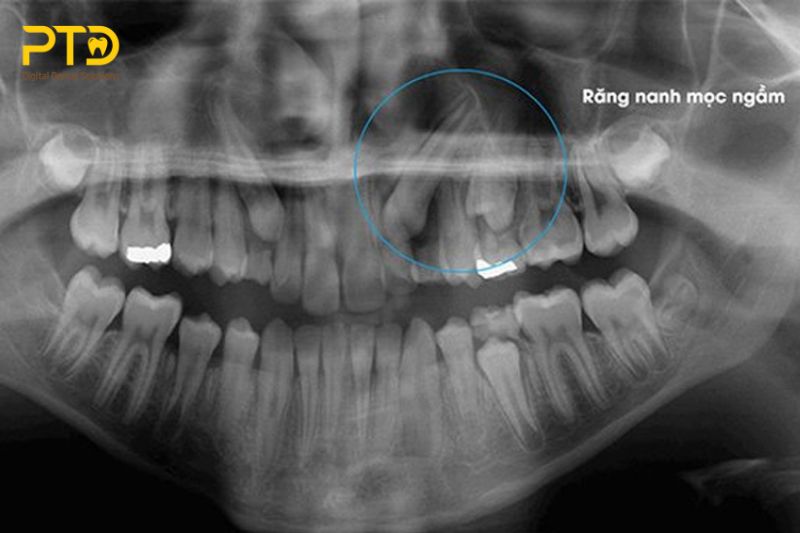 Răng nanh mọc ngầm có thể được để lại tại chỗ