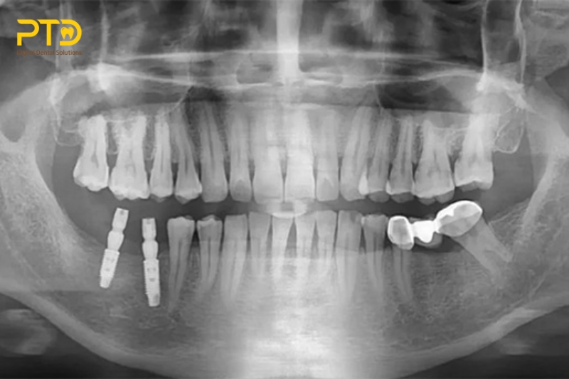 Hướng dẫn của ADA/FDA về lựa chọn bệnh nhân chụp phim X quang