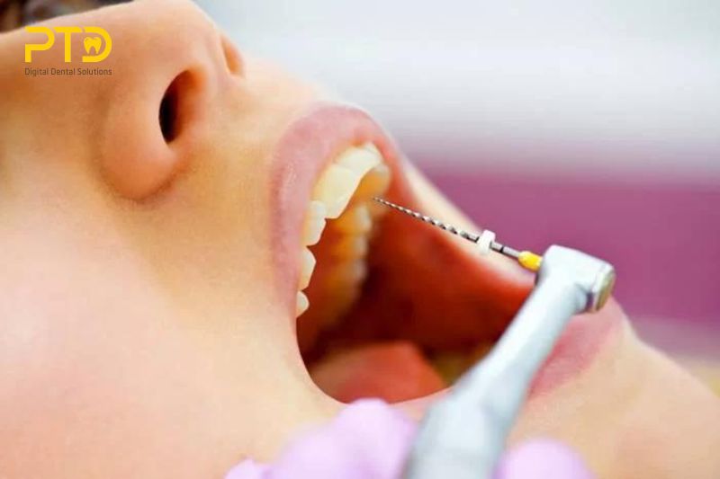 Tại sao các phòng khám nha khoa nên đầu tư vào thiết bị nội nha?