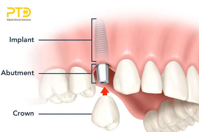 Tổng quan về phương pháp trồng răng Implant