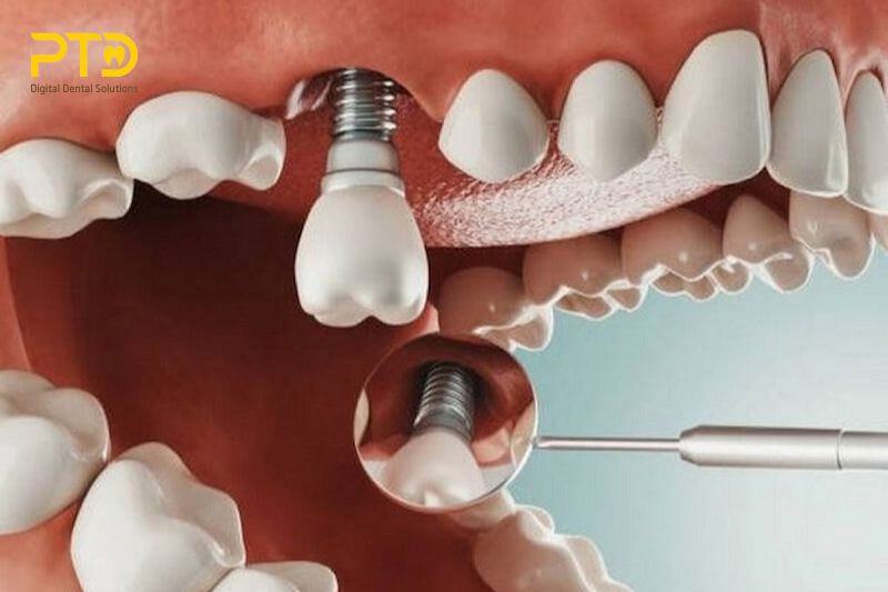 Ưu điểm của phương pháp trồng răng implant so với các phương pháp khác 