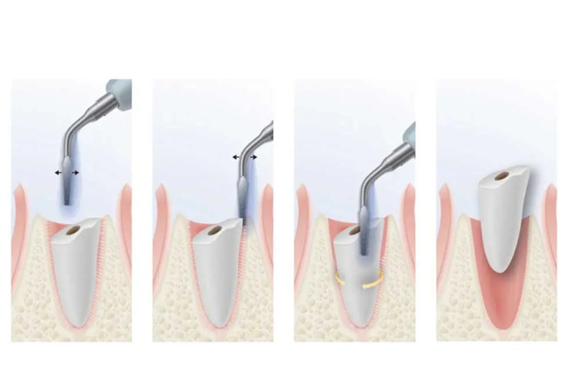 Máy Piezotome ứng dụng được nhiều trong nha khoa